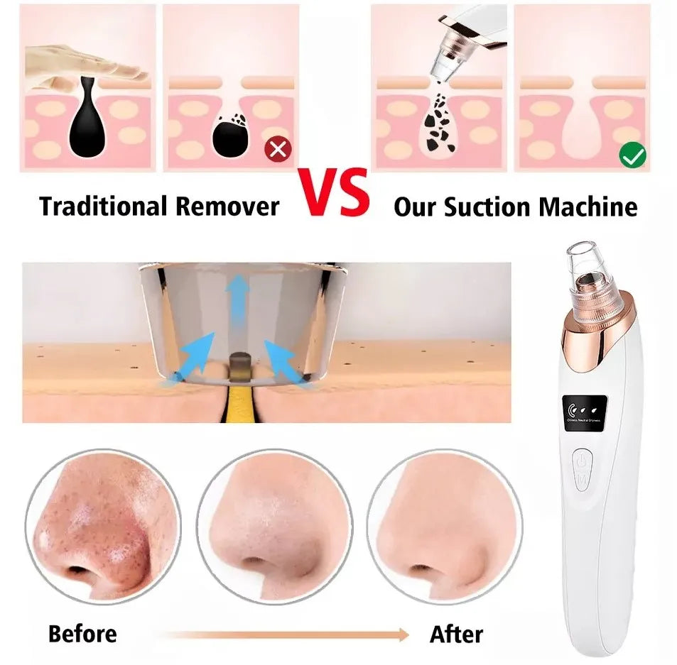 Blackhead Remover Machine